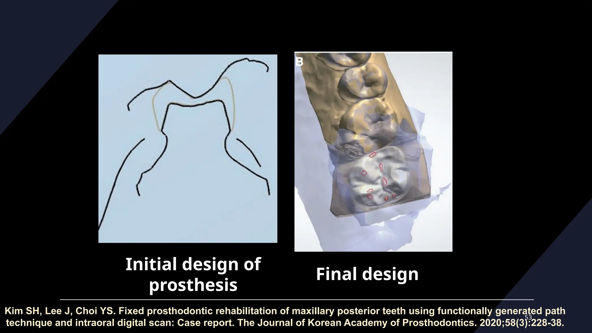 53
Initial design of
prosthesis
Final design
Kim SH, Lee J, Choi YS. Fixed prosthodontic rehabilitation of maxillary posterior teeth using functionally generated path
technique and intraoral digital scan: Case report. The Journal of Korean Academy of Prosthodontics. 2020;58(3):228-38.
 