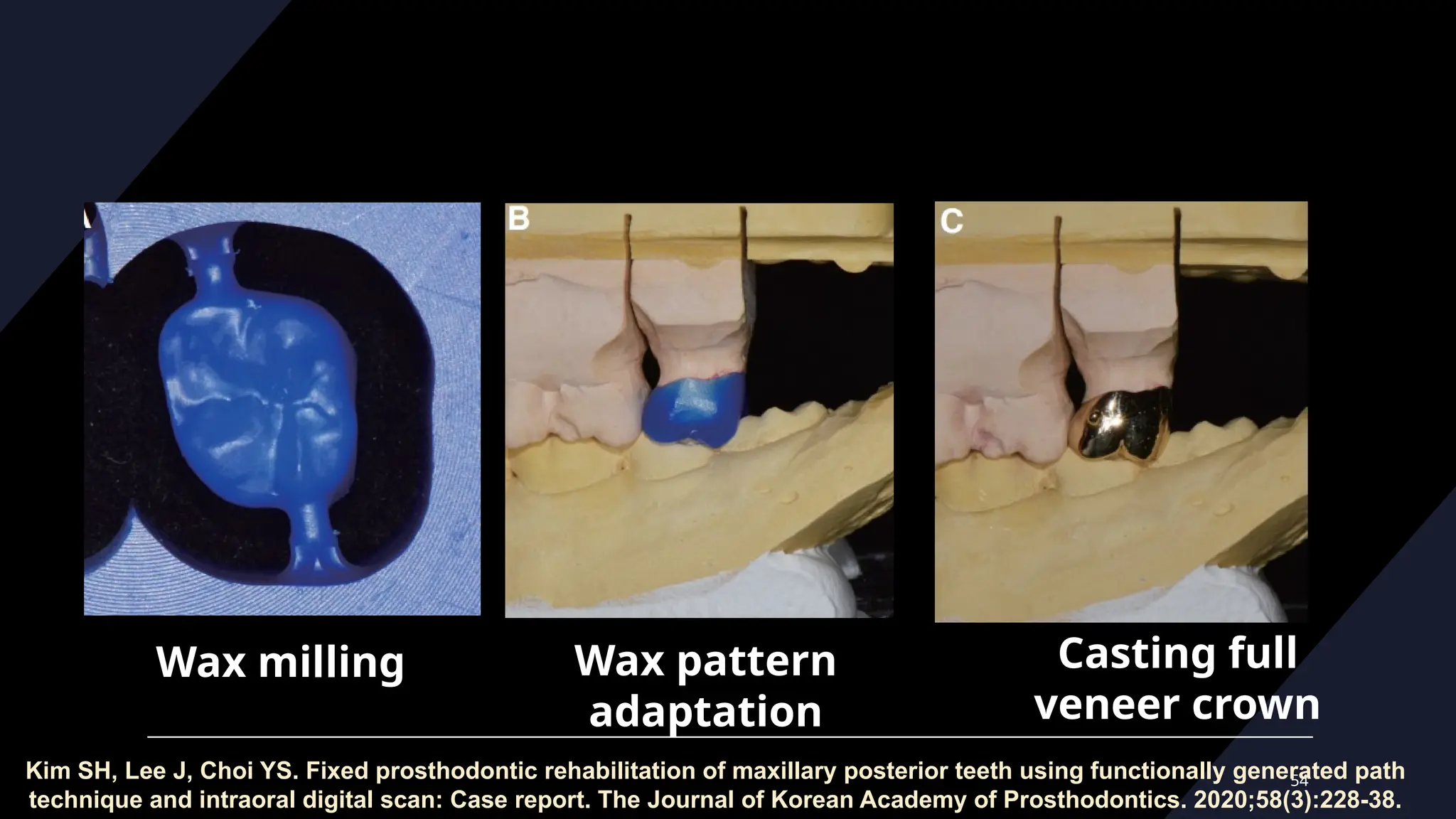 54
Wax milling Wax pattern
adaptation
Casting full
veneer crown
Kim SH, Lee J, Choi YS. Fixed prosthodontic rehabilitation of maxillary posterior teeth using functionally generated path
technique and intraoral digital scan: Case report. The Journal of Korean Academy of Prosthodontics. 2020;58(3):228-38.
 