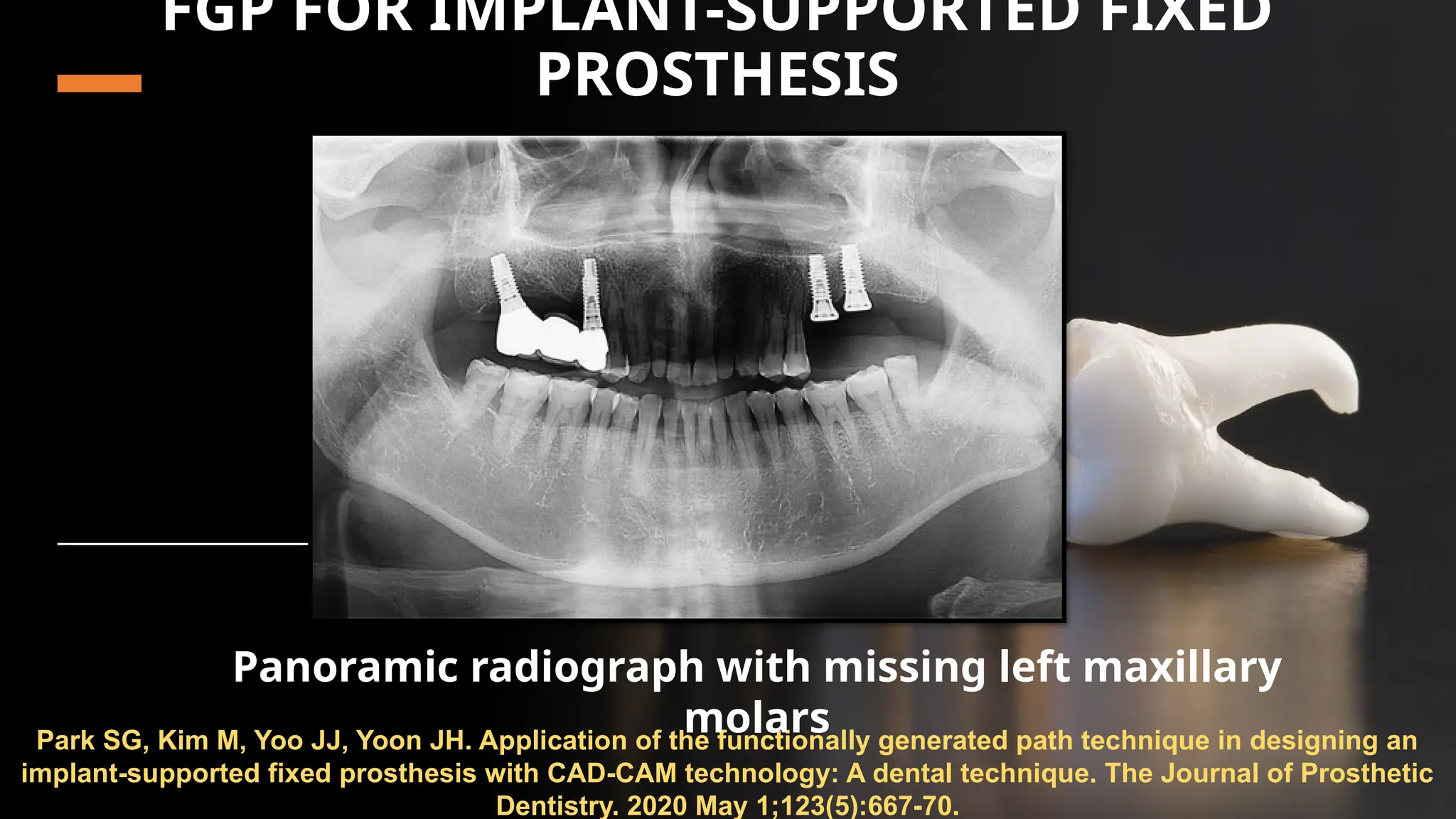 56
FGP FOR IMPLANT-SUPPORTED FIXED
PROSTHESIS
Park SG, Kim M, Yoo JJ, Yoon JH. Application of the functionally generated path technique in designing an
implant-supported fixed prosthesis with CAD-CAM technology: A dental technique. The Journal of Prosthetic
Dentistry. 2020 May 1;123(5):667-70.
Panoramic radiograph with missing left maxillary
molars
 