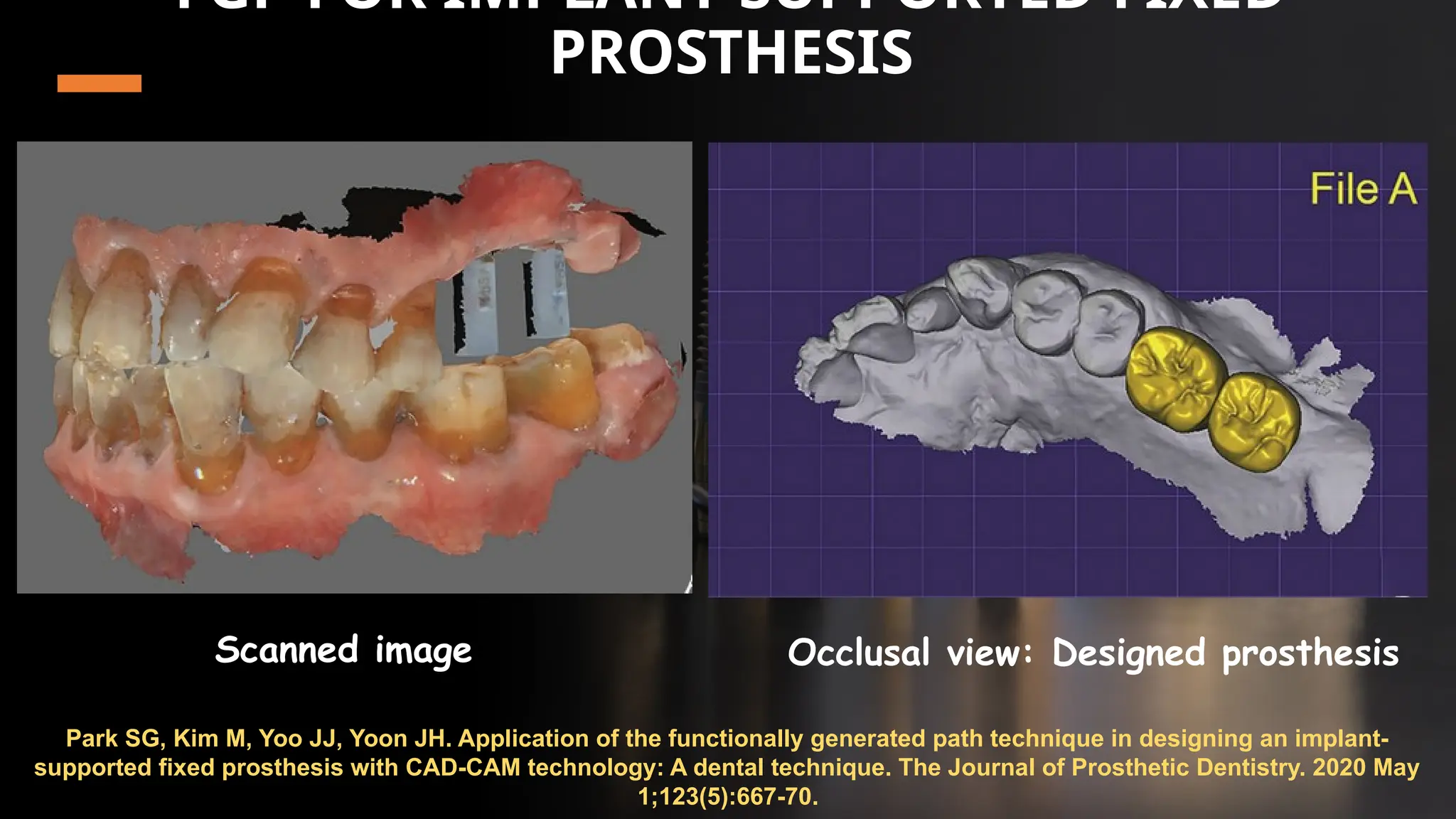57
FGP FOR IMPLANT-SUPPORTED FIXED
PROSTHESIS
Park SG, Kim M, Yoo JJ, Yoon JH. Application of the functionally generated path technique in designing an implant-
supported fixed prosthesis with CAD-CAM technology: A dental technique. The Journal of Prosthetic Dentistry. 2020 May
1;123(5):667-70.
Scanned image Occlusal view: Designed prosthesis
 