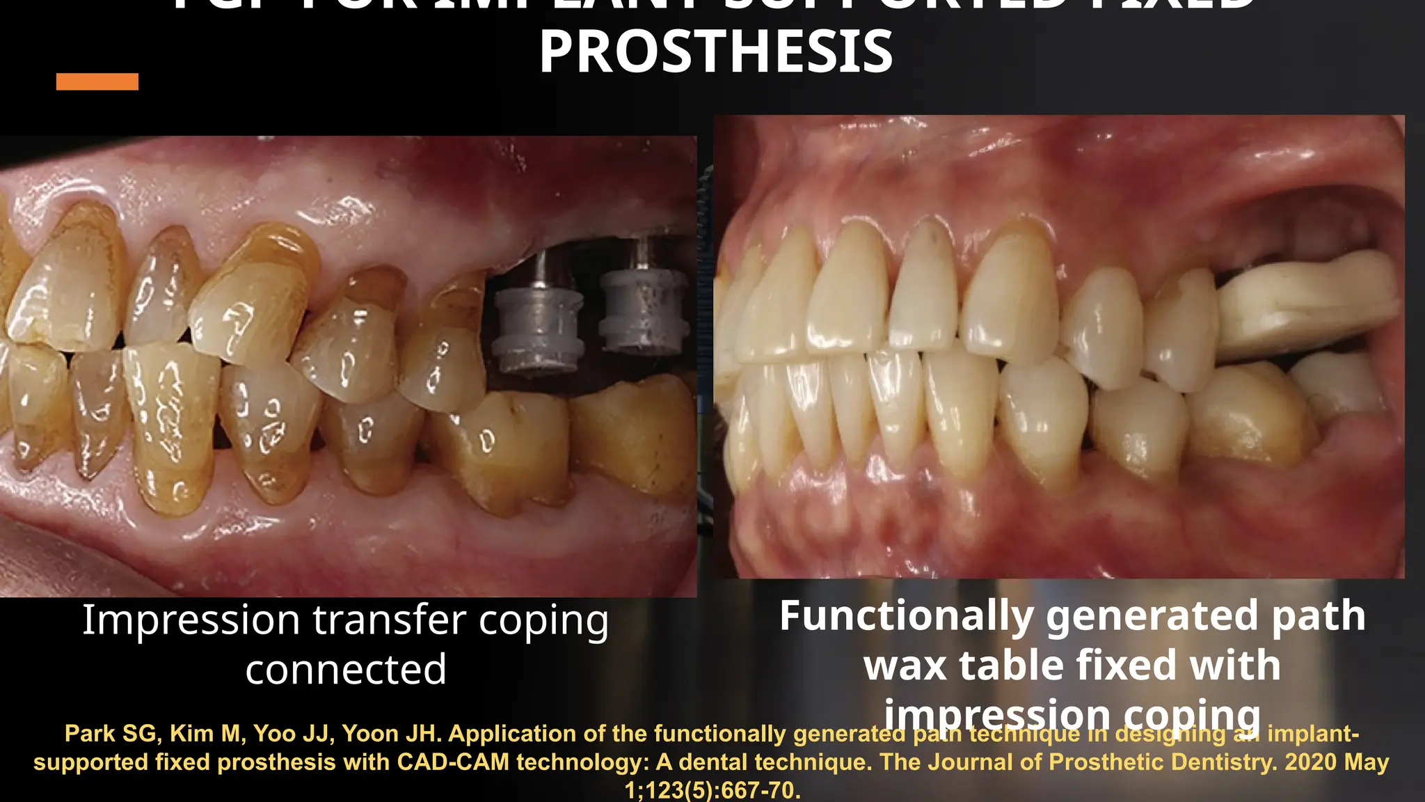 58
FGP FOR IMPLANT-SUPPORTED FIXED
PROSTHESIS
Park SG, Kim M, Yoo JJ, Yoon JH. Application of the functionally generated path technique in designing an implant-
supported fixed prosthesis with CAD-CAM technology: A dental technique. The Journal of Prosthetic Dentistry. 2020 May
1;123(5):667-70.
Impression transfer coping
connected
Functionally generated path
wax table fixed with
impression coping
 