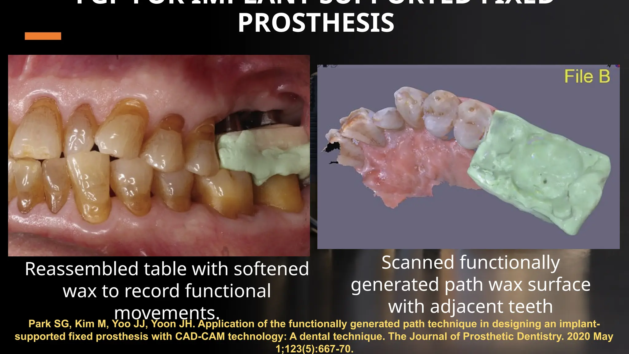 59
FGP FOR IMPLANT-SUPPORTED FIXED
PROSTHESIS
Park SG, Kim M, Yoo JJ, Yoon JH. Application of the functionally generated path technique in designing an implant-
supported fixed prosthesis with CAD-CAM technology: A dental technique. The Journal of Prosthetic Dentistry. 2020 May
1;123(5):667-70.
Reassembled table with softened
wax to record functional
movements.
Scanned functionally
generated path wax surface
with adjacent teeth
 