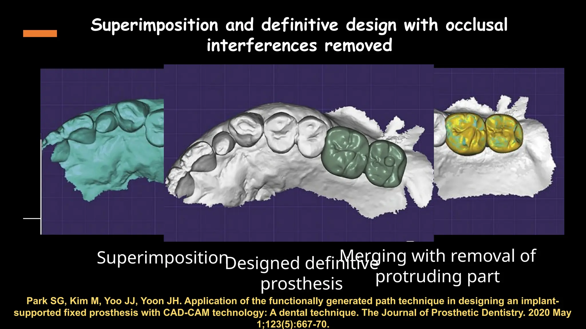 60
Park SG, Kim M, Yoo JJ, Yoon JH. Application of the functionally generated path technique in designing an implant-
supported fixed prosthesis with CAD-CAM technology: A dental technique. The Journal of Prosthetic Dentistry. 2020 May
1;123(5):667-70.
Superimposition
Superimposition and definitive design with occlusal
interferences removed
Merging with removal of
protruding part
Designed definitive
prosthesis
 
