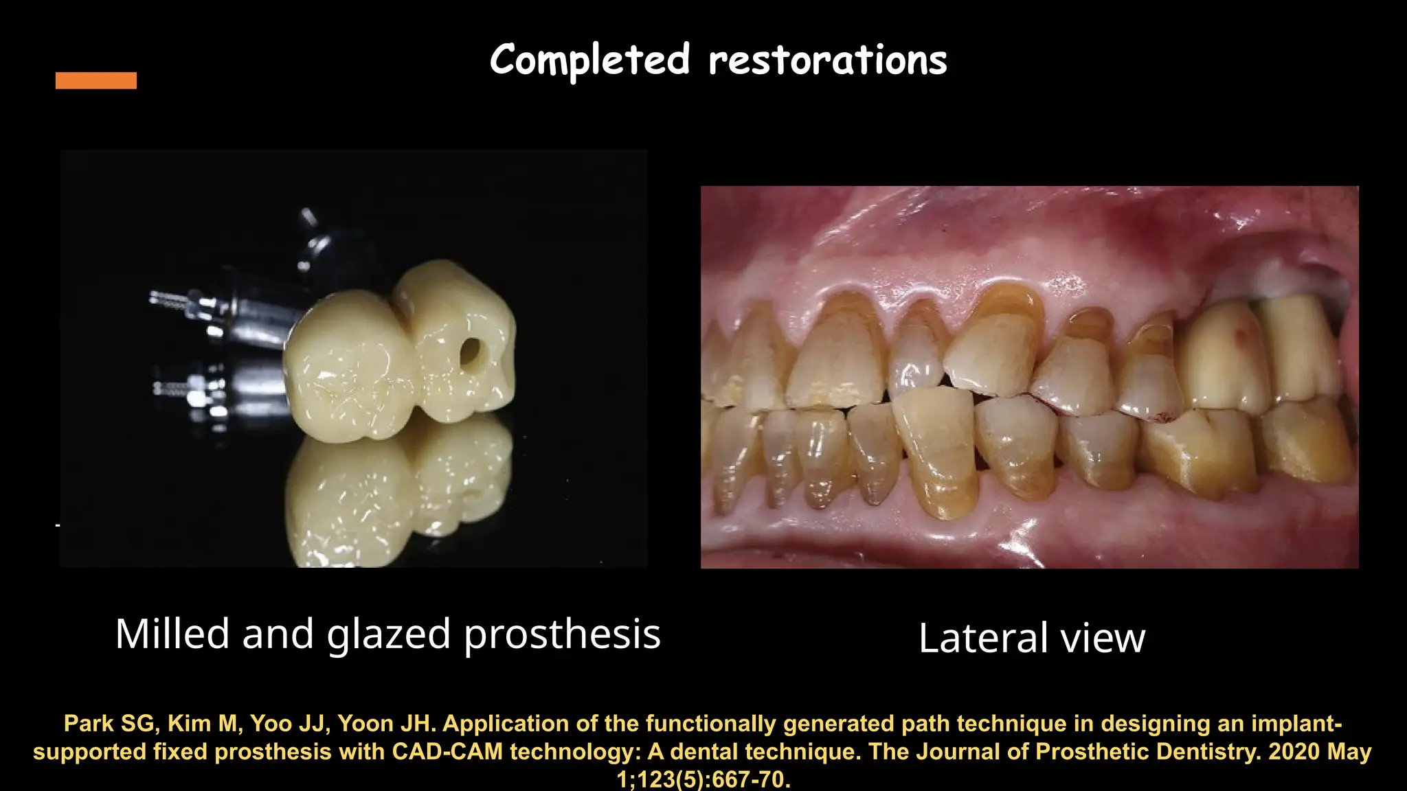 61
Park SG, Kim M, Yoo JJ, Yoon JH. Application of the functionally generated path technique in designing an implant-
supported fixed prosthesis with CAD-CAM technology: A dental technique. The Journal of Prosthetic Dentistry. 2020 May
1;123(5):667-70.
Milled and glazed prosthesis
Completed restorations
Lateral view
 