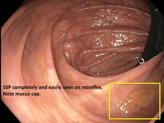 SSP completely and easily seen on retroflex.
Note mucus cap.
 