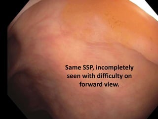 Same SSP, incompletely
seen with difficulty on
forward view.
 