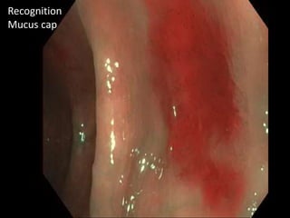 Recognition
Mucus cap
 