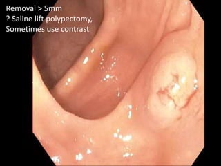 Removal > 5mm
? Saline lift polypectomy,
Sometimes use contrast
 