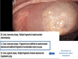 Reminder to
Review for other
neoplasia
 