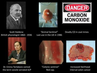 Scott Haldene
British physiologist 1860 - 1936
“Animal Sentinel”
Last use in the UK in 1986
“Colonic sentinel”
Red cap.
Increased likelihood
Interval colon cancer
Dr. Emina Torlakovic coined
the term sessile serrated A/P
Deadly CO in coal mines
 