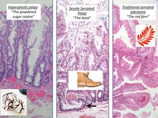 Hyperplastic polyp
“The powdered
sugar cookie”
Sessile Serrated
Polyp
“The boot”
Traditional serrated
adenoma
“The red fern”
 