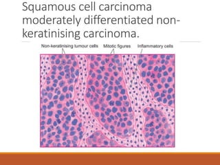 Squamous cell carcinoma
moderately differentiated non-
keratinising carcinoma.
 