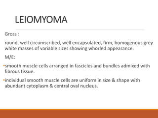 LEIOMYOMA
Gross :
round, well circumscribed, well encapsulated, firm, homogenous grey
white masses of variable sizes showing whorled appearance.
M/E:
•smooth muscle cells arranged in fascicles and bundles admixed with
fibrous tissue.
•individual smooth muscle cells are uniform in size & shape with
abundant cytoplasm & central oval nucleus.
 