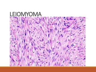 LEIOMYOMA
 