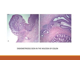 ENDOMETRIOSIS SEEN IN THE MUCOSA OF COLON
 