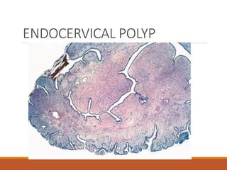 ENDOCERVICAL POLYP
 