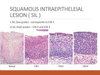SQUAMOUS INTRAEPITHELEIAL
LESION ( SIL )
L-SIL (low grade) - corresponds to CIN 1
H-SIL (high grade) – CIN 2 and CIN 3
 