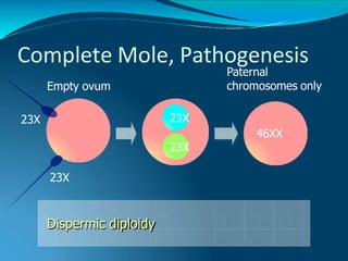 Complete Mole, Pathogenesis
Empty ovum
23X
Dispermic diploidy
Paternal
chromosomes only
23X 23X
46XX
23X
 