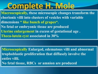 Complete H. Mole
Macroscopically, these microscopic changes transform the
chorionic villi into clusters of vesicles with variable
dimensions “ like bunch of grapes“.
No fetal or embryonic tissue are produced
Uterine enlargement in excess of gestational age .
Theca-lutein cyst associated in 30%
Microscopically Enlarged, edematous villi and abnormal
trophoblastic proliferation that diffusely involve the
entire villi.
No fetal tissue, RBCs or amnion are produced
 
