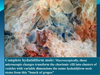 Complete hydatidiform mole: Macroscopically, these
microscopic changes transform the chorionic villi into clusters of
vesicles with variable dimensions the name hydatidiform mole
stems from this "bunch of grapes"
 