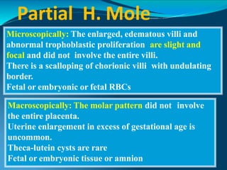 Partial H. Mole
Microscopically: The enlarged, edematous villi and
abnormal trophoblastic proliferation are slight and
focal and did not involve the entire villi.
There is a scalloping of chorionic villi with undulating
border.
Fetal or embryonic or fetal RBCs
Macroscopically: The molar pattern did not involve
the entire placenta.
Uterine enlargement in excess of gestational age is
uncommon.
Theca-lutein cysts are rare
Fetal or embryonic tissue or amnion
 