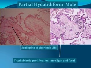 Scalloping of chorionic villi
Partial Hydatidiform Mole
Trophoblastic proliferation are slight and focal
 