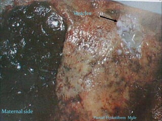 Partial Hydatiform Mole
Vesicles
Maternal side
 