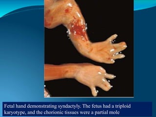Fetal hand demonstrating syndactyly. The fetus had a triploid
karyotype, and the chorionic tissues were a partial mole
 