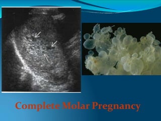Complete Molar Pregnancy
 