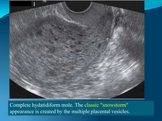 Complete hydatidiform mole. The classic "snowstorm"
appearance is created by the multiple placental vesicles.
 