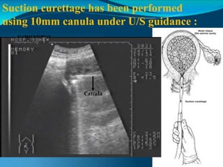 Suction curettage has been performed
using 10mm canula under U/S guidance :
E
El
l SH
SHE
ER
RBIN
BINY
Y
H
O
S
H
O
S
P
P
Canula
 