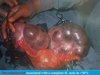 Theca-lutein cyst associated with a complete H. mole in >30%
 