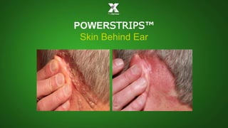 POWERSTRIPS™ 
Skin Behind Ear 
 