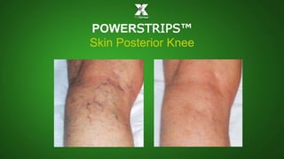 POWERSTRIPS™ 
Skin Posterior Knee 
 