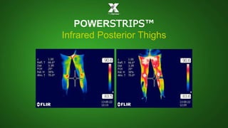 POWERSTRIPS™ 
Infrared Posterior Thighs 
 
