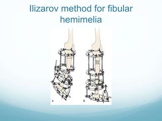 Ilizarov method for fibular
hemimelia
 