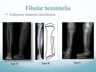 Fibular hemimelia
 Achterman–Kalamchi classification
Type IA Type IB Type II
 