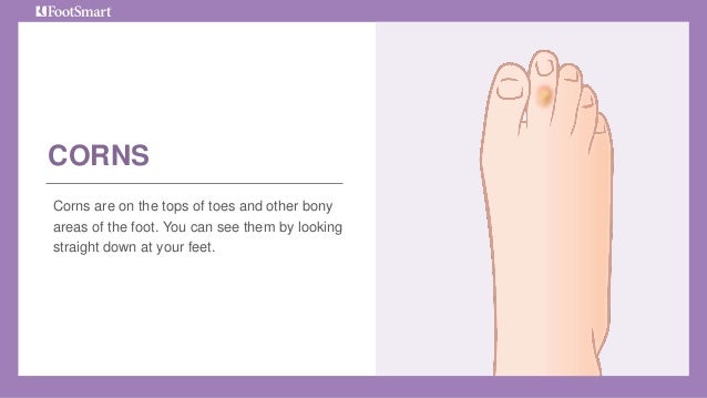 preventing corns on feet