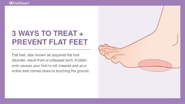 3 Ways to treat and prevent flat feet