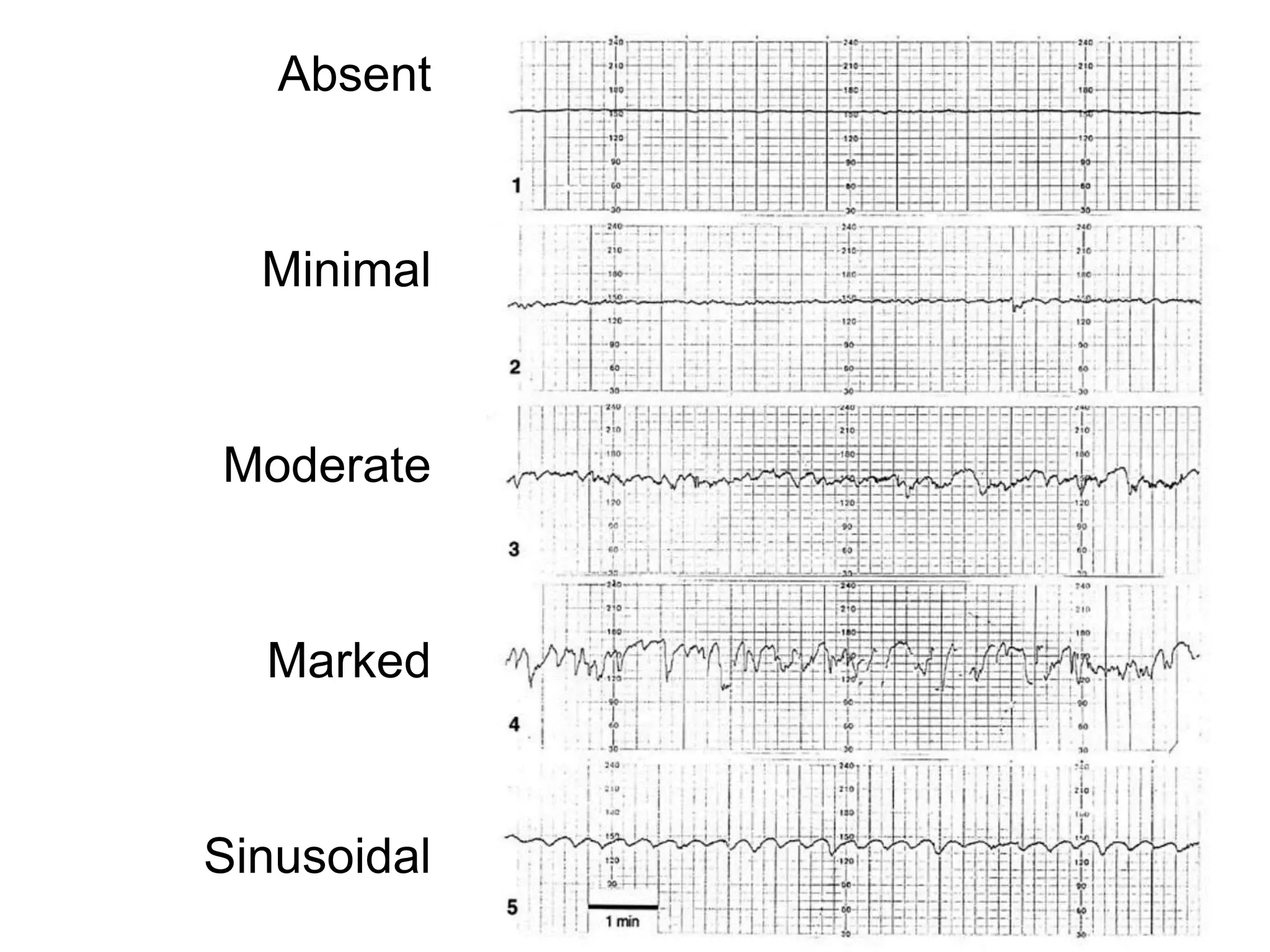 Absent


  Minimal


Moderate


  Marked


Sinusoidal
 