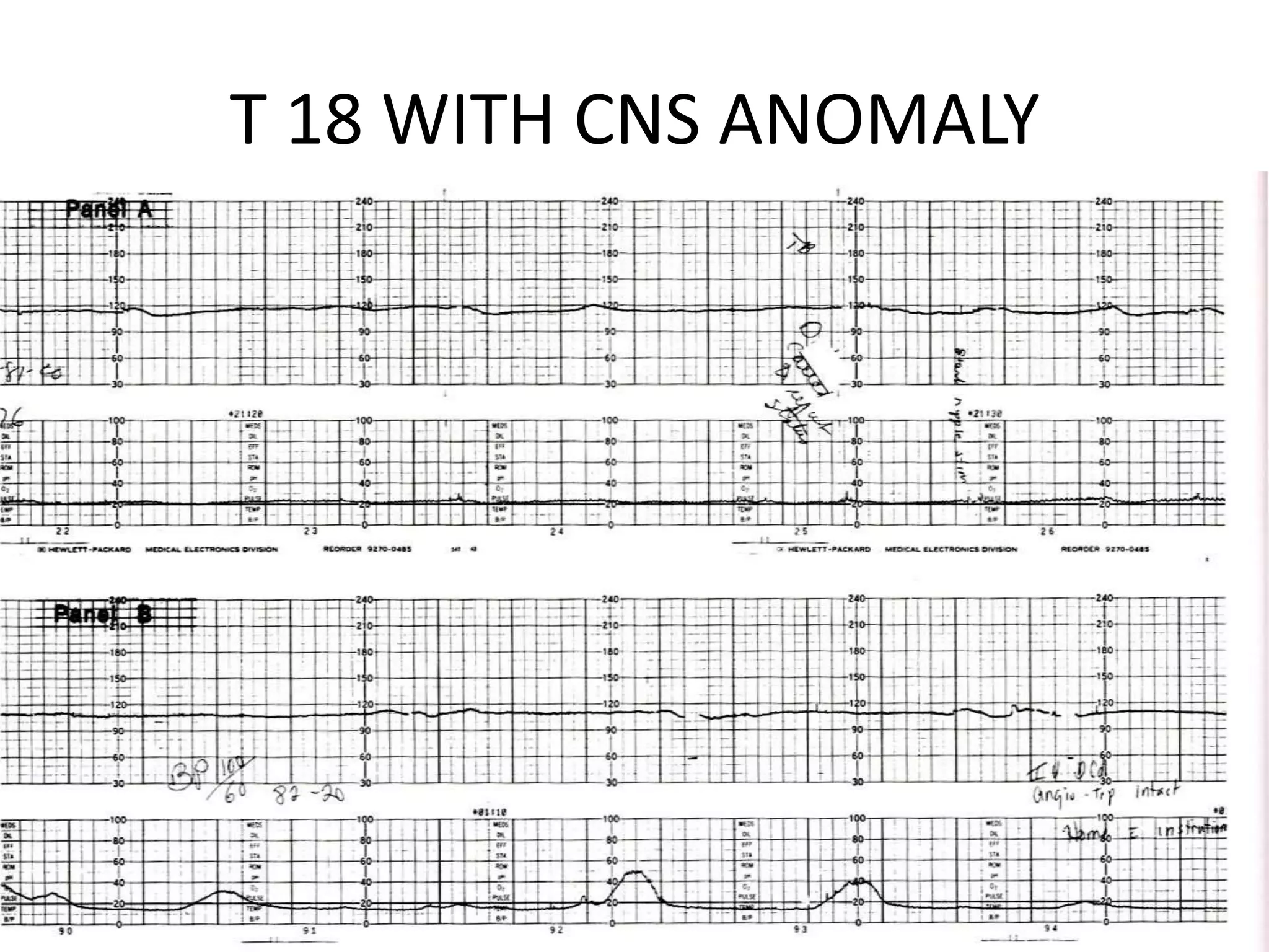 T 18 WITH CNS ANOMALY
 