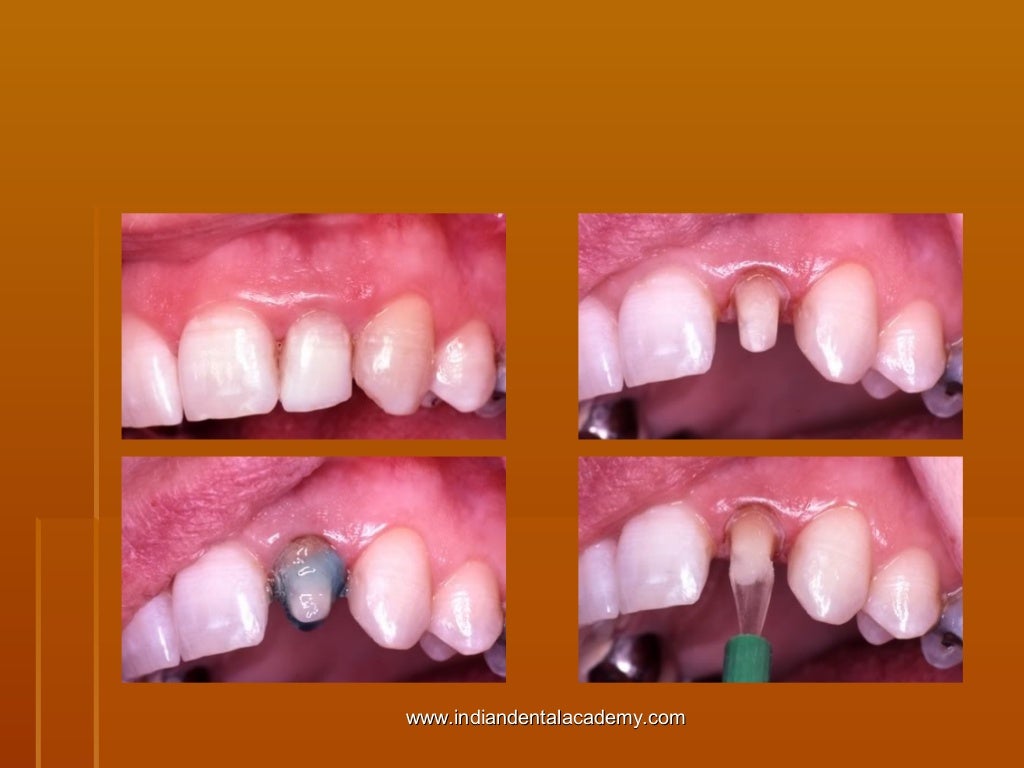 Fiber based post systems/ cosmetic dentistry training