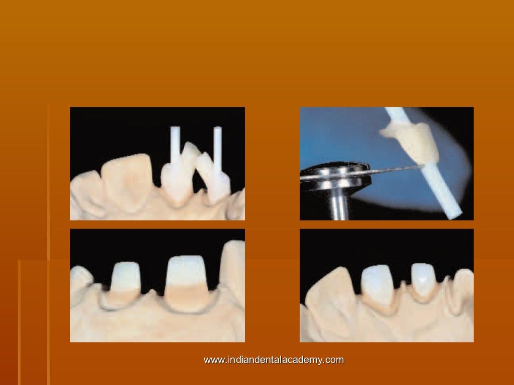 Fiber based post systems/ cosmetic dentistry training