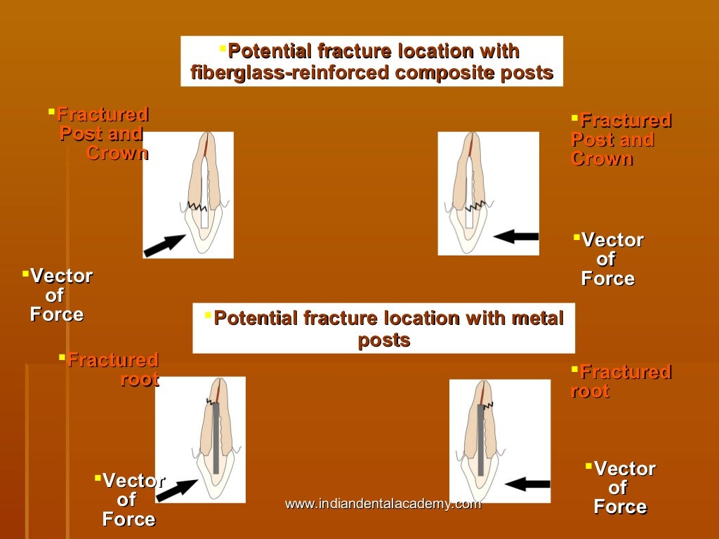 Fiber based post systems/ cosmetic dentistry training
