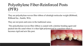 Polyethelyne Ribbon FIBER POST in conservative dentistry and endododntics | PPTX