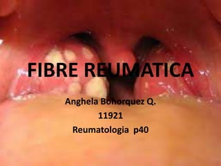 FIBRE REUMATICA 
Anghela Bohorquez Q. 
11921 
Reumatologia p40 
 