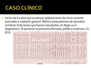  Varón de 61 años que acude por palpitaciones de inicio reciente
asociadas a malestar general. Refiere antecedentes de episodios
similares (más leves) que fueron estudiados sin llegar a un
diagnóstico. El paciente se presenta afectado, pálido y sudoroso. Su
ECG:
 