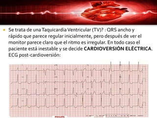  Se trata de unaTaquicardiaVentricular (TV)? : QRS ancho y
rápido que parece regular inicialmente, pero después de ver el
monitor parece claro que el ritmo es irregular. En todo caso el
paciente está inestable y se decide CARDIOVERSIÓN ELÉCTRICA.
ECG post-cardioversión:
 