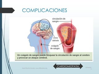 COMPLICACIONES
03/06/201
5
Heart Rhythm Society, www.HRSonline.org
CARDIOMIOPATIA
 