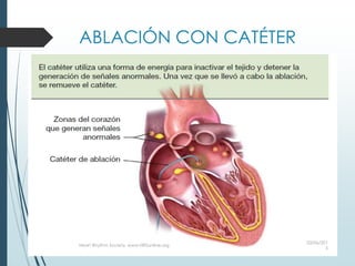 ABLACIÓN CON CATÉTER
03/06/201
5
Heart Rhythm Society, www.HRSonline.org
 